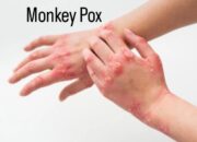 Cegah Mpox Dengan Edukasi Lengkap Dan Akurat