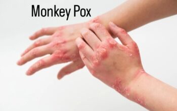 Cegah Mpox Dengan Edukasi Lengkap Dan Akurat