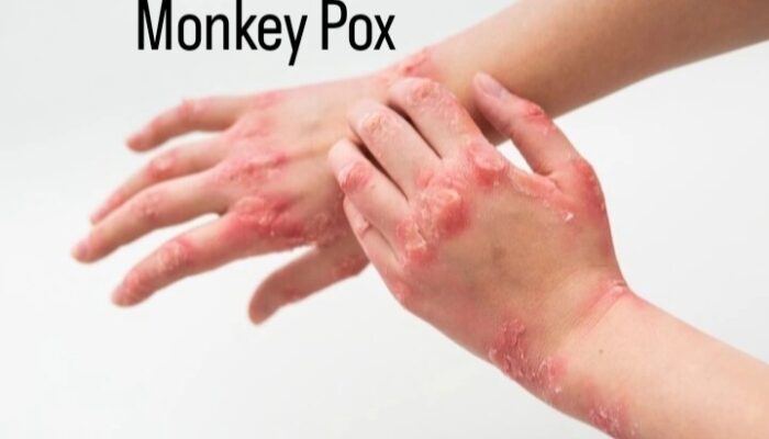 Cegah Mpox Dengan Edukasi Lengkap Dan Akurat