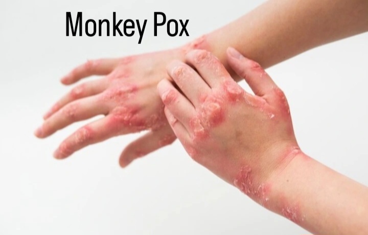 Cegah Mpox Dengan Edukasi Lengkap Dan Akurat